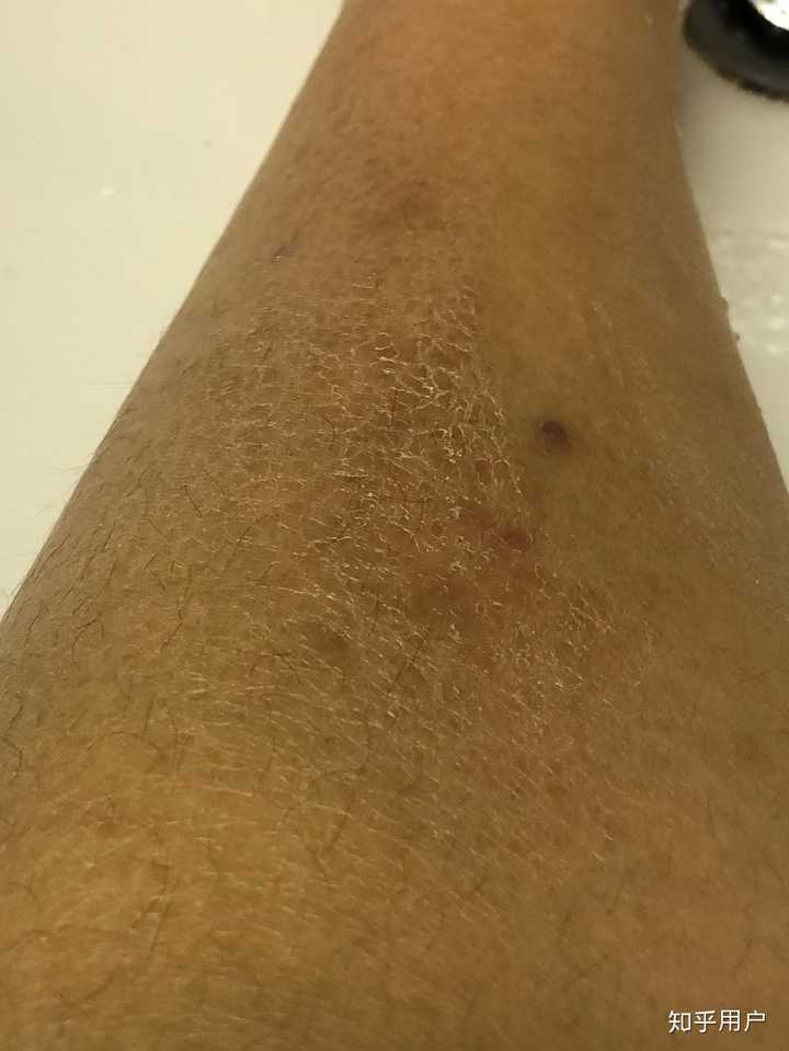 如何應(yīng)對(duì)保溫材料引起的皮膚癢問題妙招